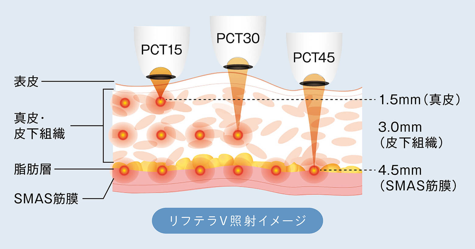 リフテラV照射イメージ